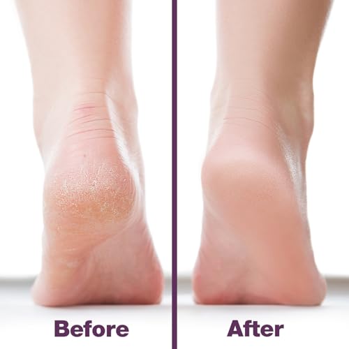 Probelle Double Sided Nickel Foot File Callus Remover, Purple - color: Purple