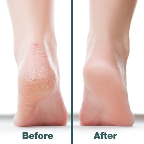 Probelle Double Sided Nickel Foot File Callus Remover, White - color: White