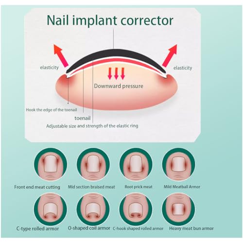 Ingrown Toenail Correction Kit