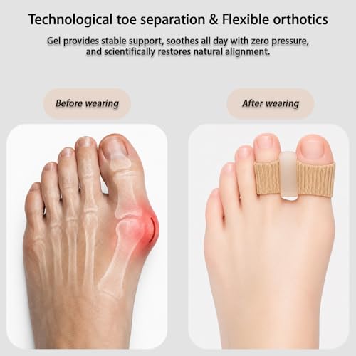 Toe Spacers for Women Men, 2 Pack Gel Big Toes Separators for Bunions-Small - size: S