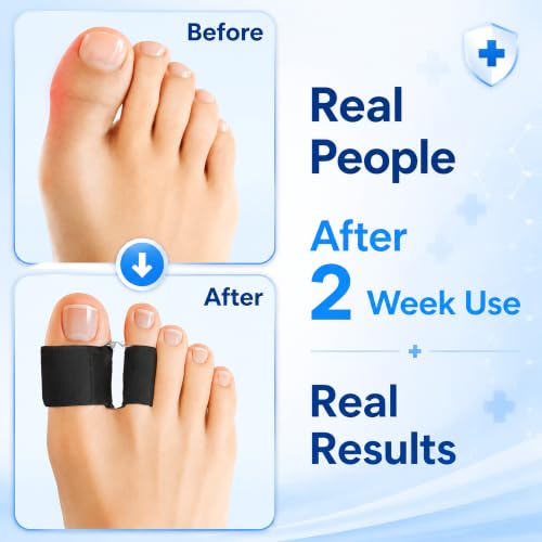 BCCKLE Big Toe Separators, 2-Loop Soft Gel Toe Spacers, 3 Sizes, Washable (Black, S:Women 5-9) - color: Black, size: S:WOMEN 5-9