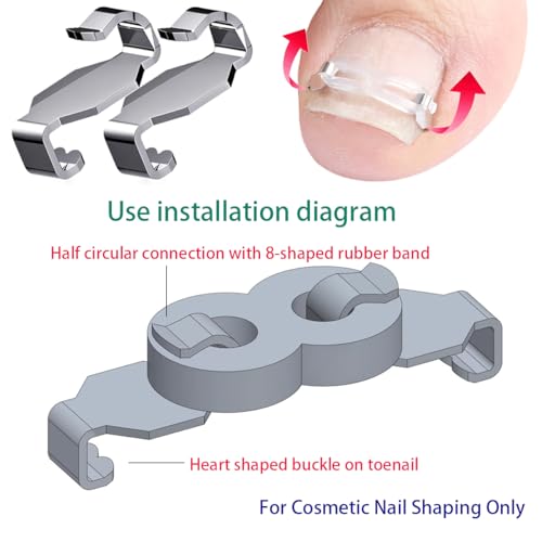 Ingrown Toenail Correction Kit