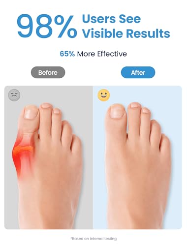Bunion Corrector, Toe Separators for Women and Men, Big Toe Alignment to Original Shape, Toe Spacers (Blue)