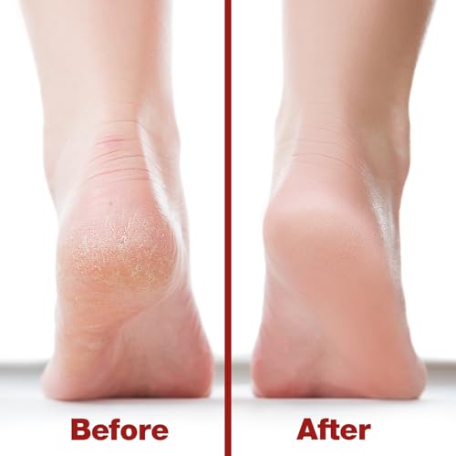 Probelle Double Sided Nickel Foot File Callus Remover, Red - color: Red
