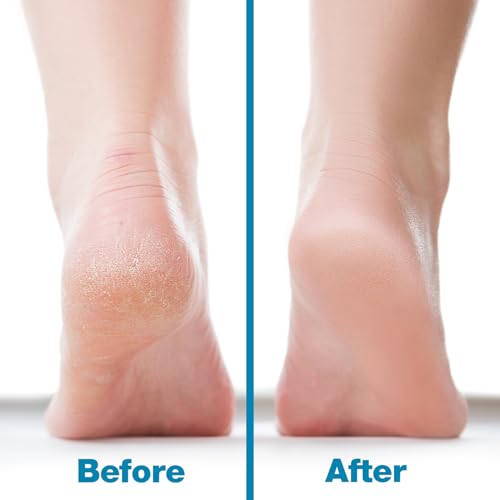 Probelle Double Sided Nickel Foot File Callus Remover, Blue - color: Blue