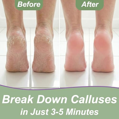 Foot Callus Remover Gel Kit: Complete At Home Callus Remover for Feet 8 oz