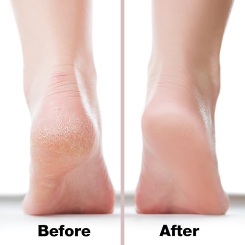 Probelle Double Sided Nickel Foot File Callus Remover, Pink - color: Pink