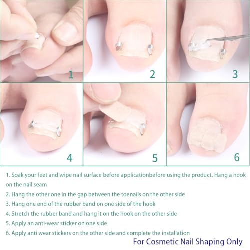 Ingrown Toenail Correction Kit