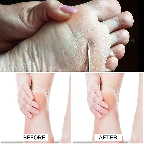 Diamond Pedicure Cylinder Bit, Stainless Steel Foot Nail Drill Bit With Teeth Pedicure Foot Calluses for Dead Skin Corns Callus Removal, Polishing Head for Nails Manicure Pedicures (3.0mm) - color: Mold B